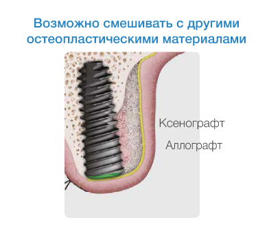 Возможно смешивать с другими остеопластическими материалами